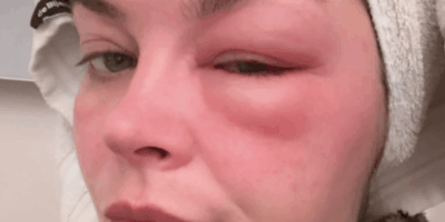 Heftig: Wat is er gebeurd met het opgezwollen gezicht van Miljuschka?