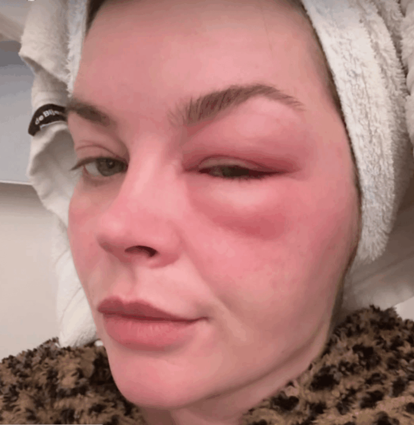 Heftig: Wat is er gebeurd met het opgezwollen gezicht van Miljuschka?